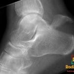 Lateral X-ray of the right calcaneum showing a beak-type avulsion fracture.