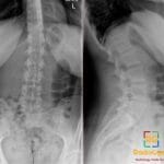 AP and lateral X-ray views of the lumbosacral spine, showing features consistent with Bertolotti's syndrome.