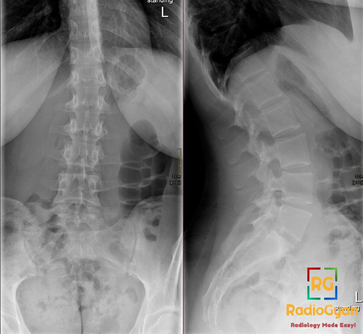 AP and lateral X-ray views of the lumbosacral spine, showing features consistent with Bertolotti's syndrome.