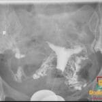 Hysterosalpingogram showing bilateral tubal block with venous intravasation of contrast in the uterus and surrounding pelvis.