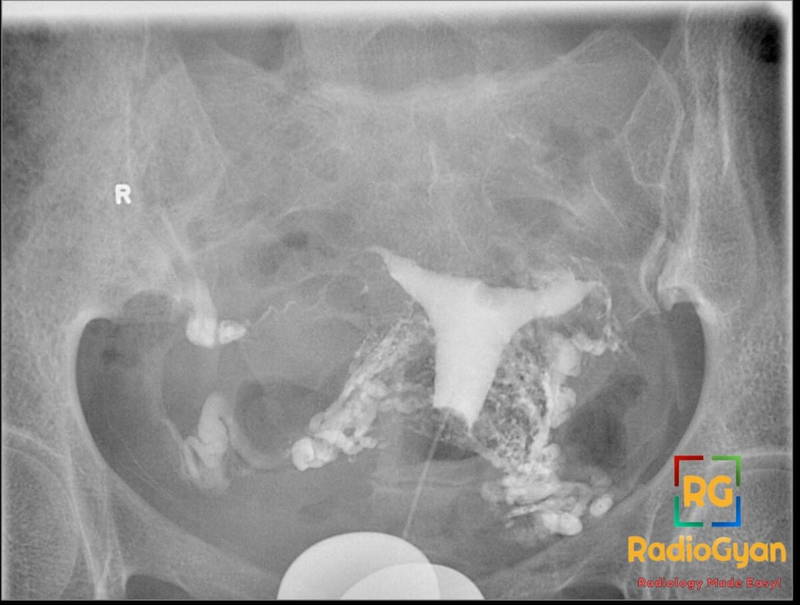 Hysterosalpingogram showing bilateral tubal block with venous intravasation of contrast in the uterus and surrounding pelvis.