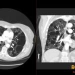 CT axial and coronal views of lungs showing widespread thin-walled cysts characteristic of Lymphangioleiomyomatosis (LAM).