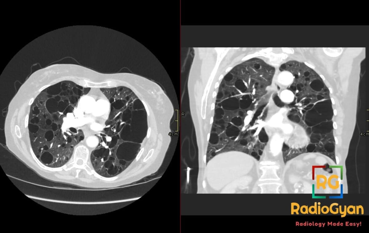 CT axial and coronal views of lungs showing widespread thin-walled cysts characteristic of Lymphangioleiomyomatosis (LAM).