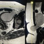 MRI image showing a Canal of Nuck cyst in the inguinal region, axial and sagittal views.