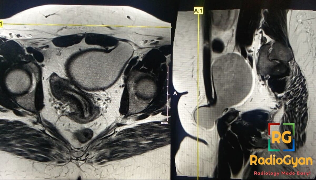 MRI image showing a Canal of Nuck cyst in the inguinal region, axial and sagittal views.