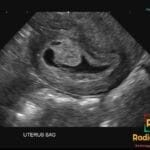 Sagittal ultrasound of the uterus showing a chorionic bump in early pregnancy.