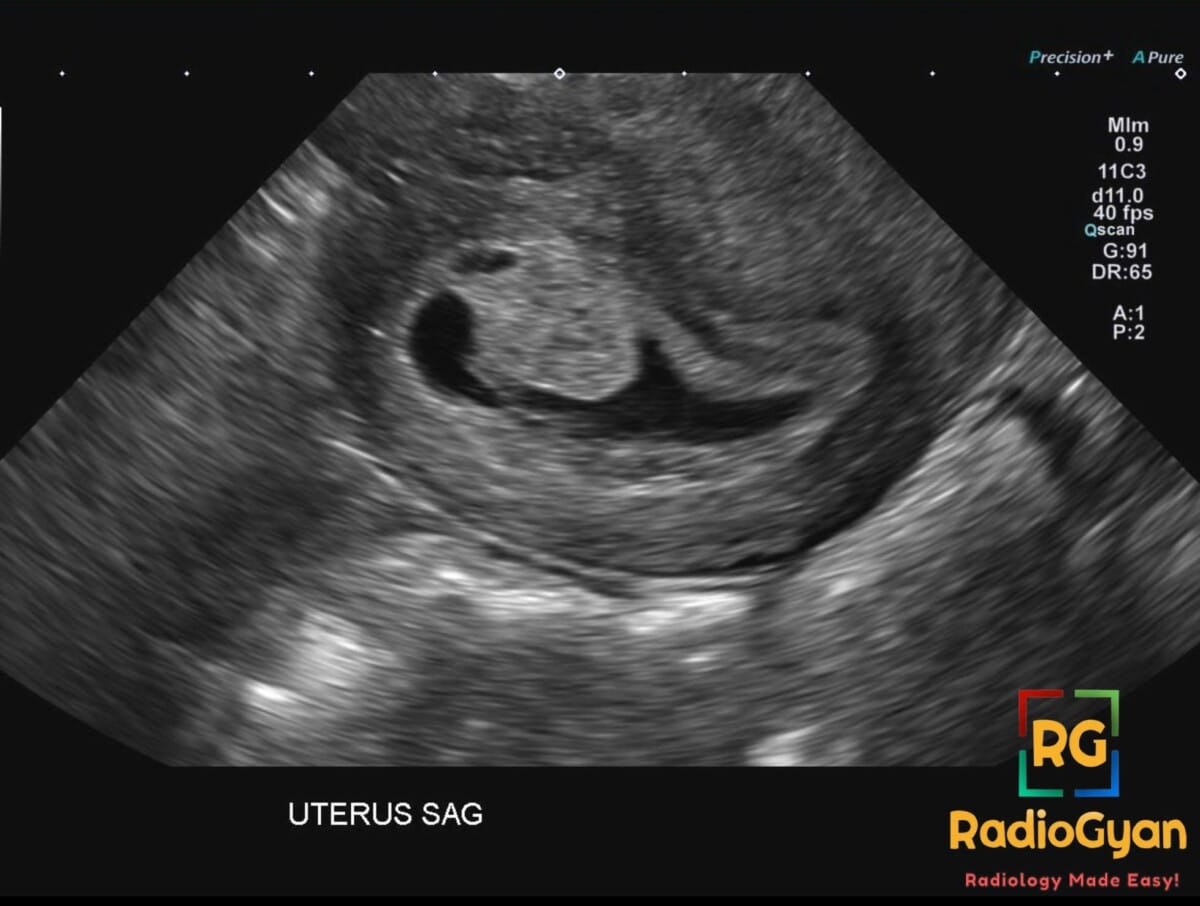 Sagittal ultrasound of the uterus showing a chorionic bump in early pregnancy.