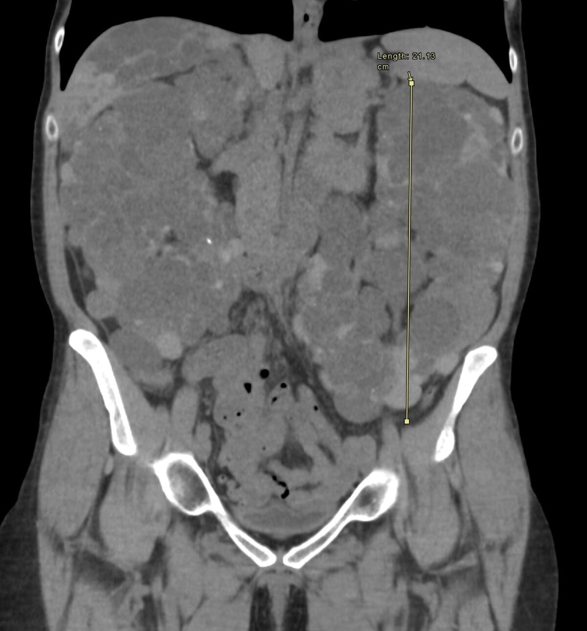 Coronal CT in ADPKD with the left kidney measured at 21.13 cm in length, illustrating kidney size measurement for total kidney volume
