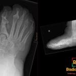 X-ray of the right diabetic foot, showing signs of advanced Charcot neuroarthropathy affecting tarsal and metatarsal bones.
