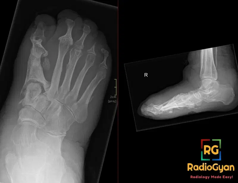X-ray of the right diabetic foot, showing signs of advanced Charcot neuroarthropathy affecting tarsal and metatarsal bones.