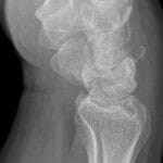 Lateral wrist X-ray showing a dorsal triquetral fracture with the characteristic 'pooping duck' sign.
