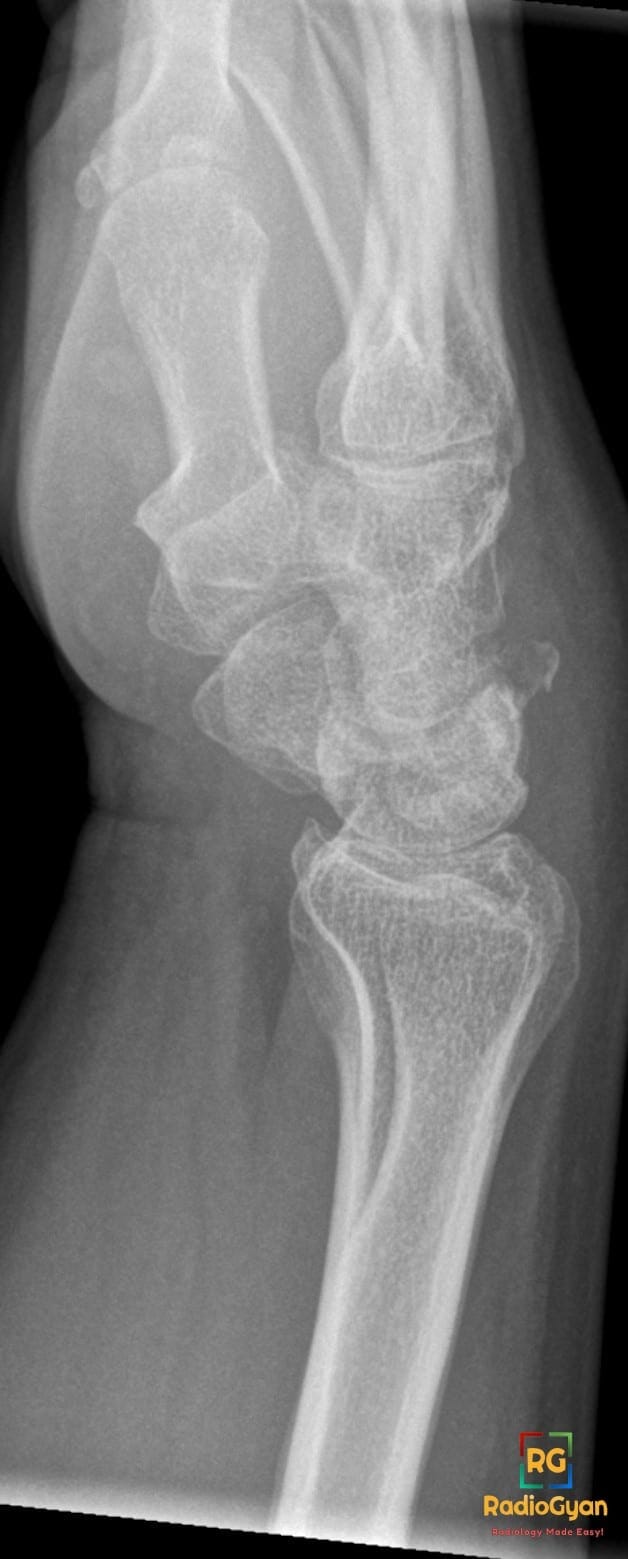 Lateral wrist X-ray showing a dorsal triquetral fracture with the characteristic 'pooping duck' sign.