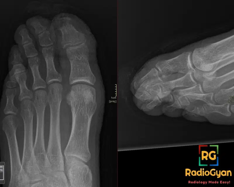 X-ray of the foot demonstrating frostbite of the first digit distal phalanx with early osteolysis.