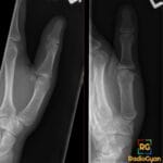 X-ray of a thumb demonstrating Gamekeeper's/Skier's thumb injury, likely ulnar collateral ligament tear.