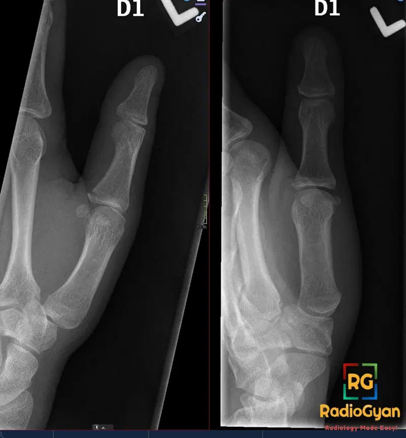 X-ray of a thumb demonstrating Gamekeeper's/Skier's thumb injury, likely ulnar collateral ligament tear.