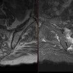 MRI pelvic bone shows sacral insufficiency fracture with Honda sign (H-sign) indicated by distinct bone marrow edema.