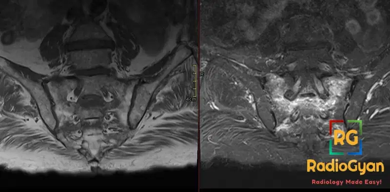 MRI pelvic bone shows sacral insufficiency fracture with Honda sign (H-sign) indicated by distinct bone marrow edema.