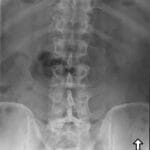 AP X-ray of lumbar spine demonstrating Inverted Napoleon Hat Sign in L5-S1 spondylolisthesis.