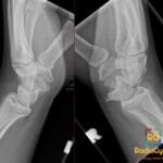 Lateral X-ray view comparing a right midcarpal central carpal dislocation with a normal left wrist.