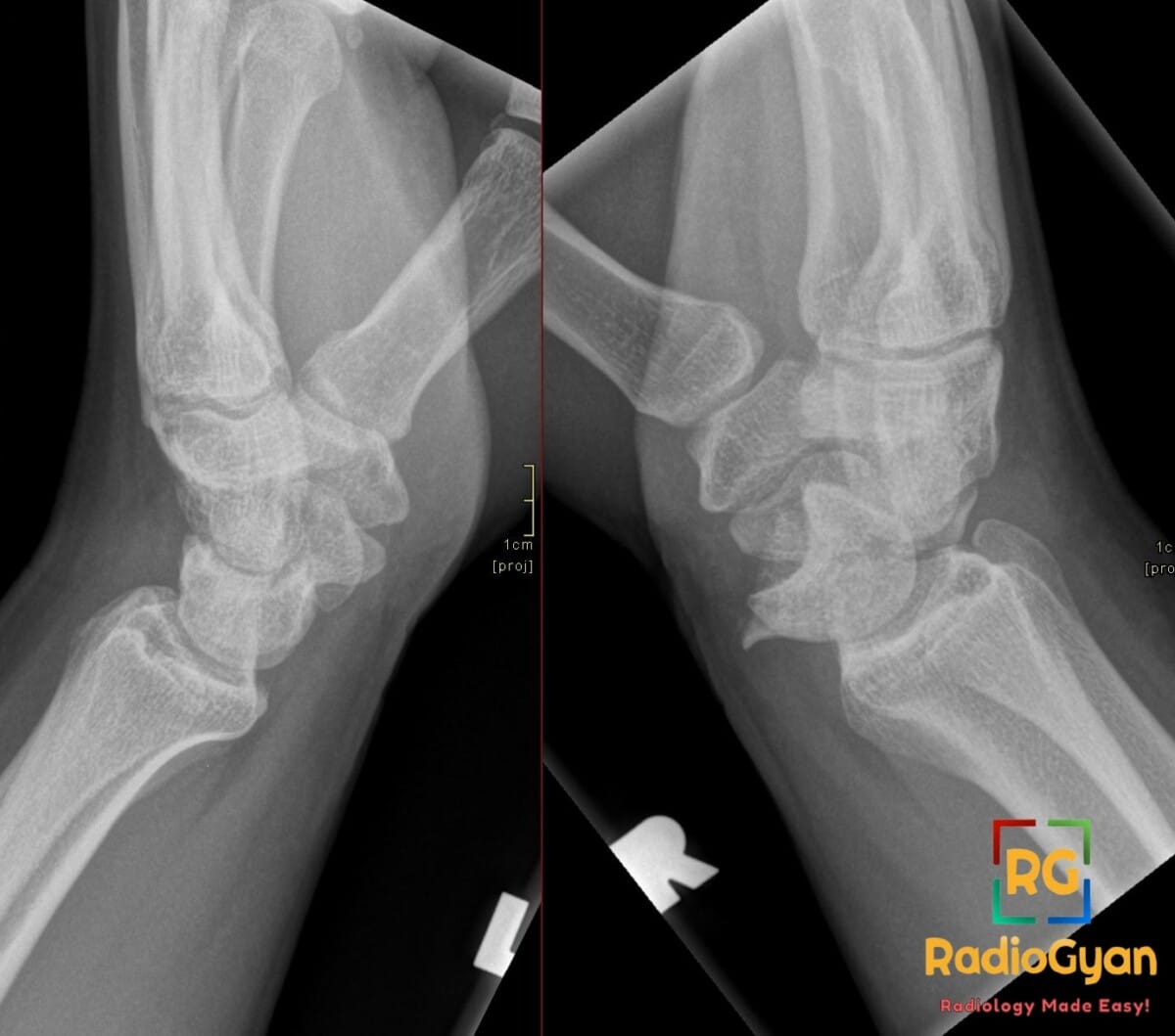 Lateral X-ray view comparing a right midcarpal central carpal dislocation with a normal left wrist.