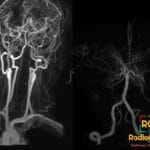 MRA depicting Moyamoya Syndrome with bilateral cervical ICA occlusion in a Sickle Cell Disease patient.