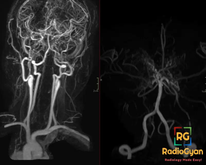 MRA depicting Moyamoya Syndrome with bilateral cervical ICA occlusion in a Sickle Cell Disease patient.