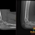 CT and X-ray images of an elbow showing olecranon process fibrous dysplasia with pathological fracture.