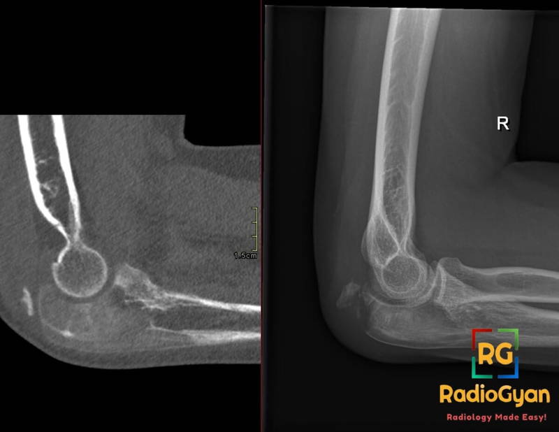 CT and X-ray images of an elbow showing olecranon process fibrous dysplasia with pathological fracture.
