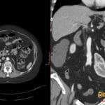 CT images showing a pancake-shaped left adrenal gland in a patient with an ectopic left kidney.