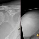 X-ray of a right shoulder showing posterior dislocation, reverse Bankart, and reverse Hill-Sachs lesions with a trough sign.