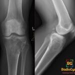 Anteroposterior and lateral knee X-rays showing a lytic lesion in the proximal tibia, consistent with a giant cell tumor.