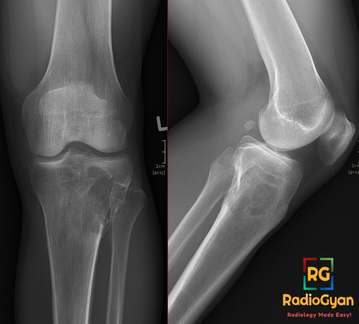 Anteroposterior and lateral knee X-rays showing a lytic lesion in the proximal tibia, consistent with a giant cell tumor.