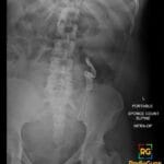 Intraoperative radiograph of the abdomen and pelvis showing a serpentine-shaped retained surgical sponge with radiopaque marker.