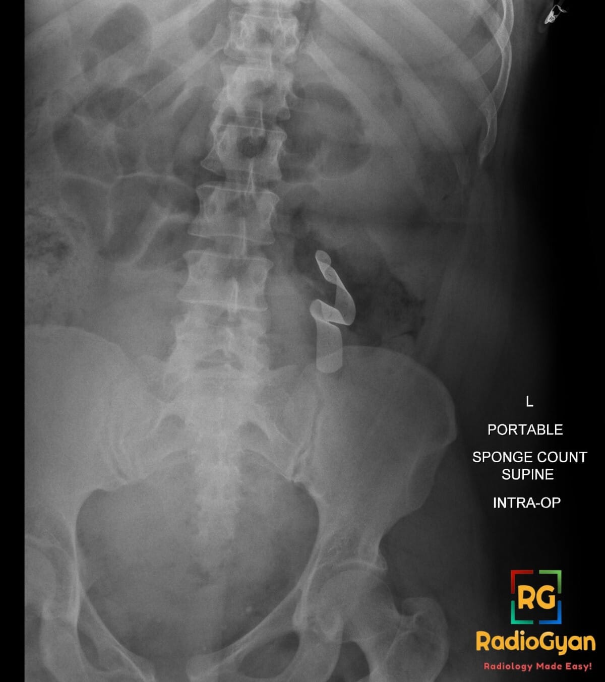 Intraoperative radiograph of the abdomen and pelvis showing a serpentine-shaped retained surgical sponge with radiopaque marker.