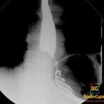 Barium swallow showing shouldering of the lower esophagus due to esophageal carcinoma.