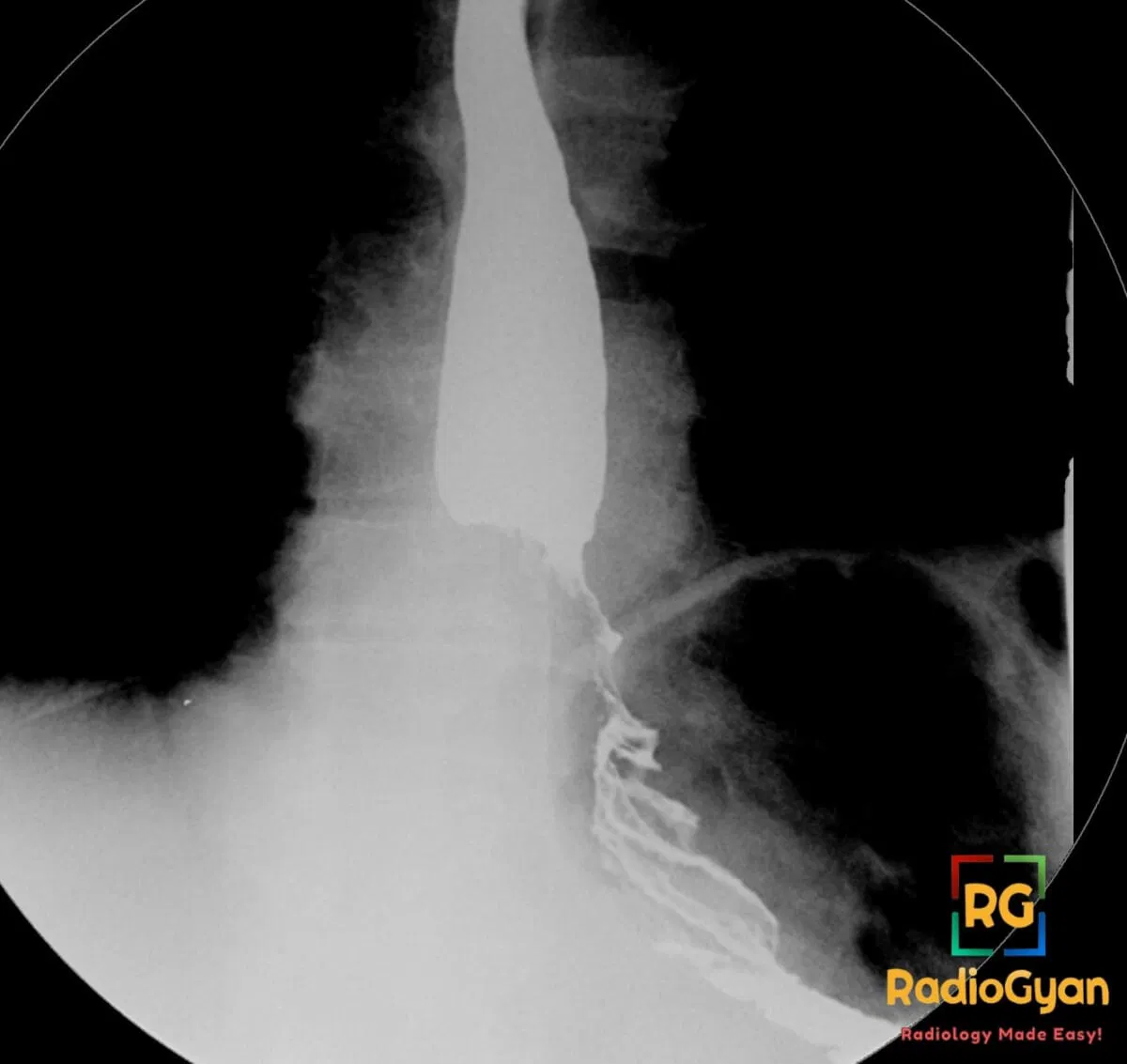 Barium swallow showing shouldering of the lower esophagus due to esophageal carcinoma.