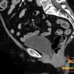 Sagittal CT scan revealing a small cystocele (bladder prolapse) in the pelvic region, with an arrow pointing to the finding.