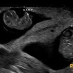 Ultrasound image showing twin-peak sign and lambda sign in a dichorionic, diamniotic twin pregnancy.