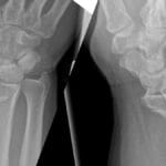 AP and lateral X-ray views of a right wrist demonstrating a Volar Barton fracture of the distal radius.