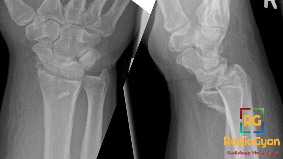 AP and lateral X-ray views of a right wrist demonstrating a Volar Barton fracture of the distal radius.