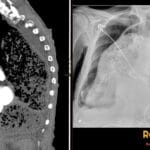 CT and X-ray showing pseudoachalia or giant achalasia with massive esophageal dilation and associated lung changes.