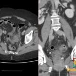 CT abdomen/pelvis showing thickening and fat stranding in the sigmoid colon consistent with diverticulitis.