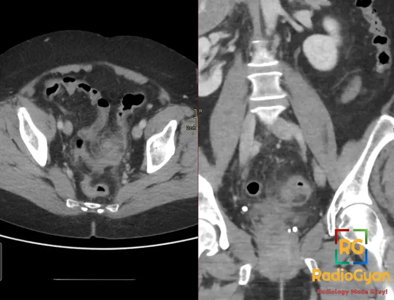 CT abdomen/pelvis showing thickening and fat stranding in the sigmoid colon consistent with diverticulitis.
