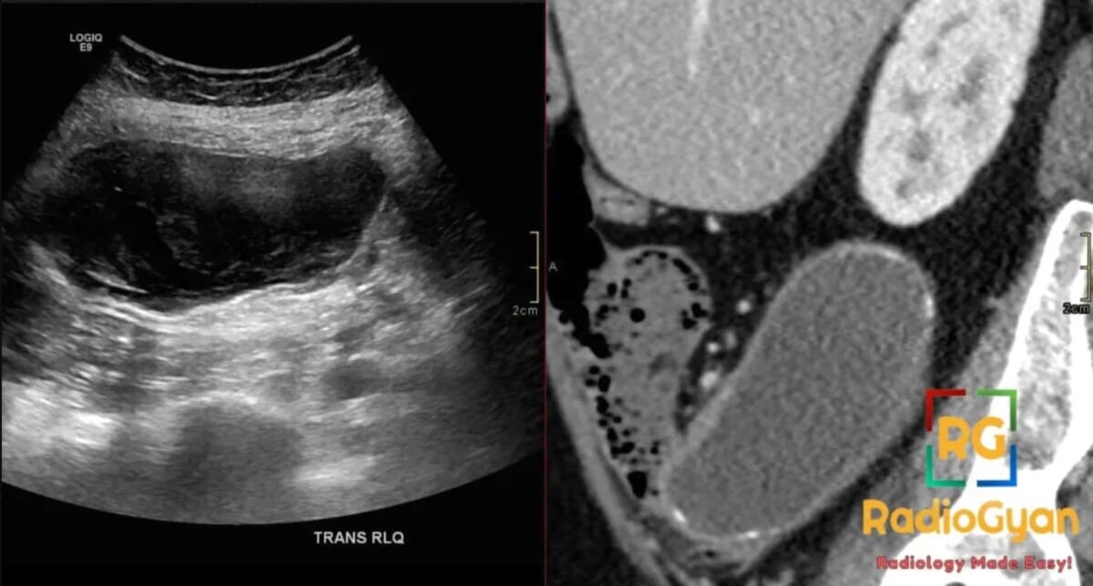 Ultrasound and CT images show an appendiceal mucocele. The ultrasound displays a cystic mass; CT shows a well-defined appendix.