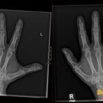 Bilateral hand X-rays showing strikingly short fourth metacarpals in both the left and right hands.