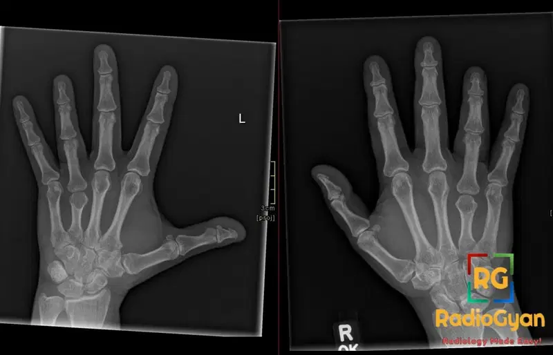 Bilateral hand X-rays showing strikingly short fourth metacarpals in both the left and right hands.