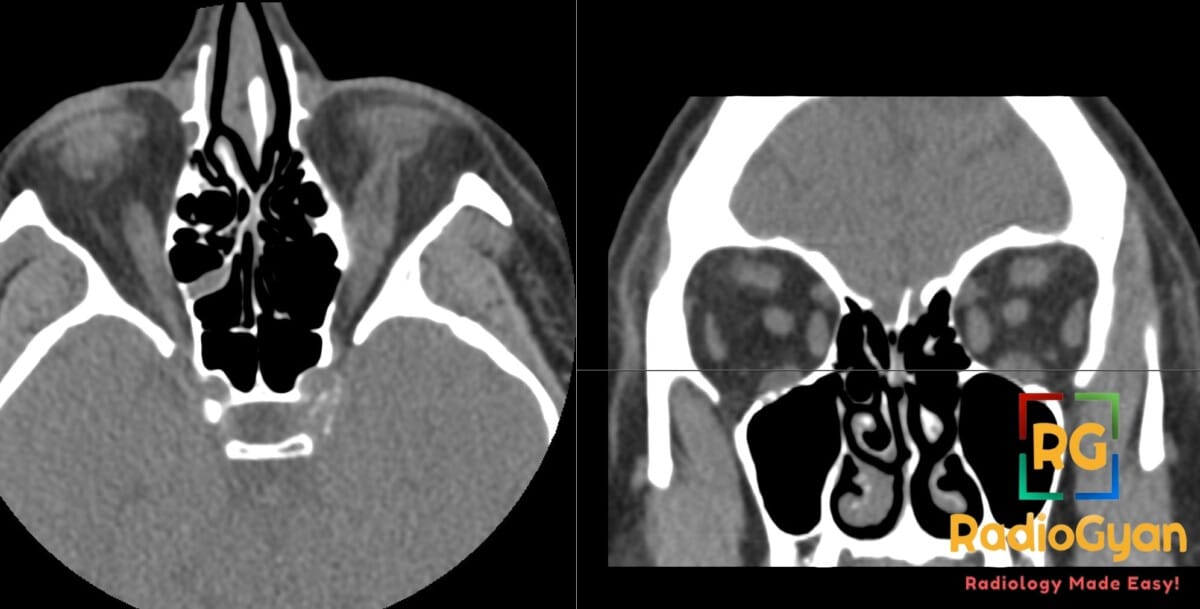 CT scan of thyroid eye disease showing inferior rectus involvement with lateral rectus sparing