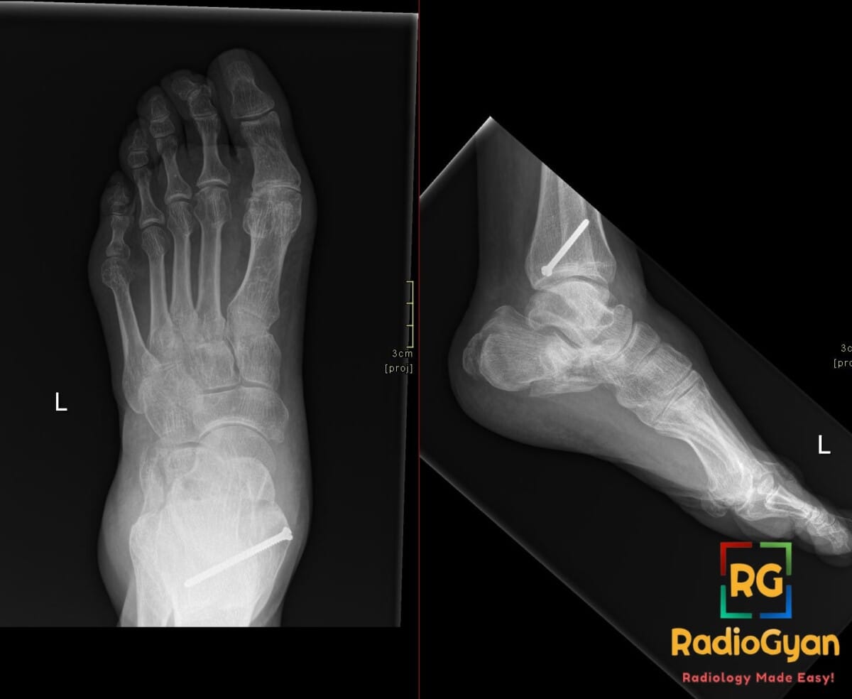 AP and lateral ankle X-rays showing a calcaneal fracture (Lover's fracture) with internal fixation.