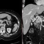 Axial and coronal CT images showing cavernous transformation of the portal vein, characterized by multiple tortuous collateral vessels.