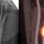 X-ray and PET scan images showing cookie-bite metastasis in the femur from lung carcinoma.